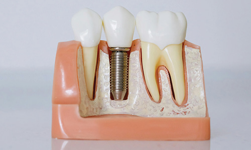 Implants