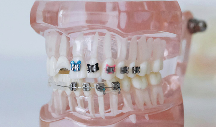 Braces & Aligners