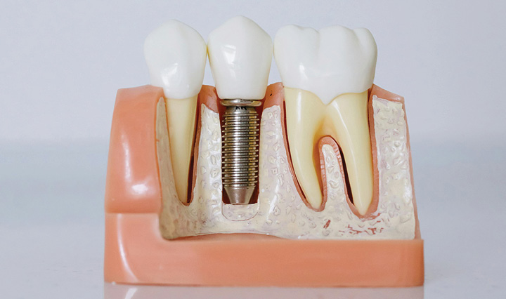Teeth Implant